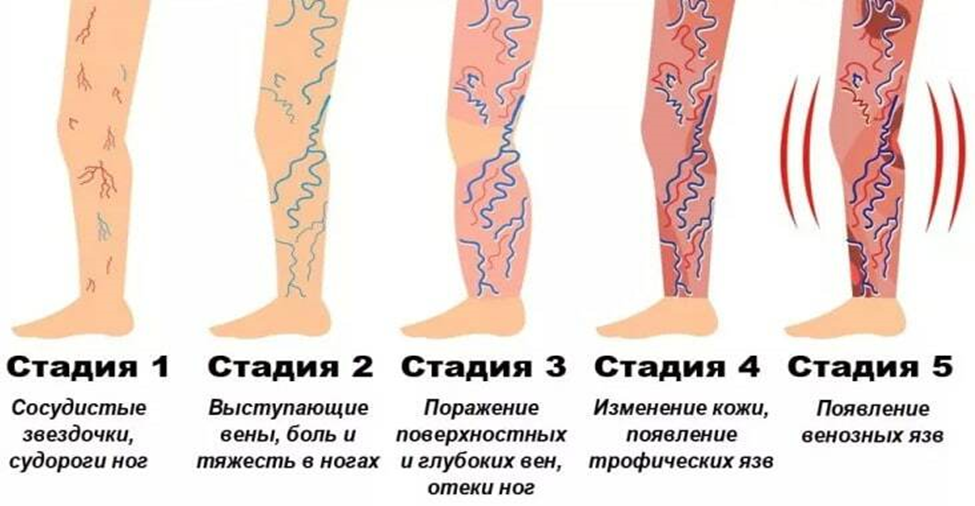 Варикоз вен ног, лечение и профилактика