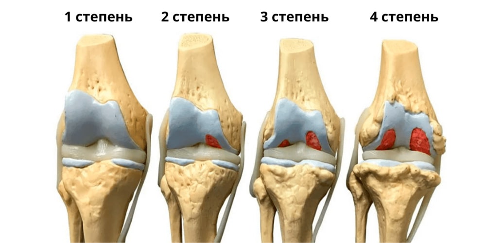 сустав3