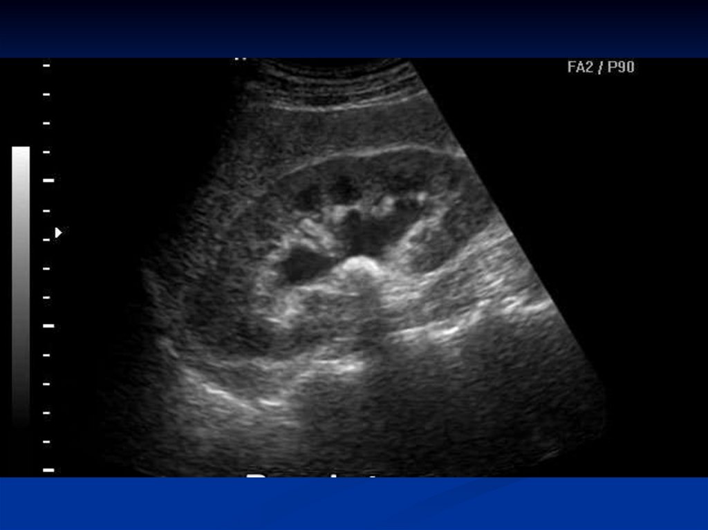 Как проводится УЗИ почек