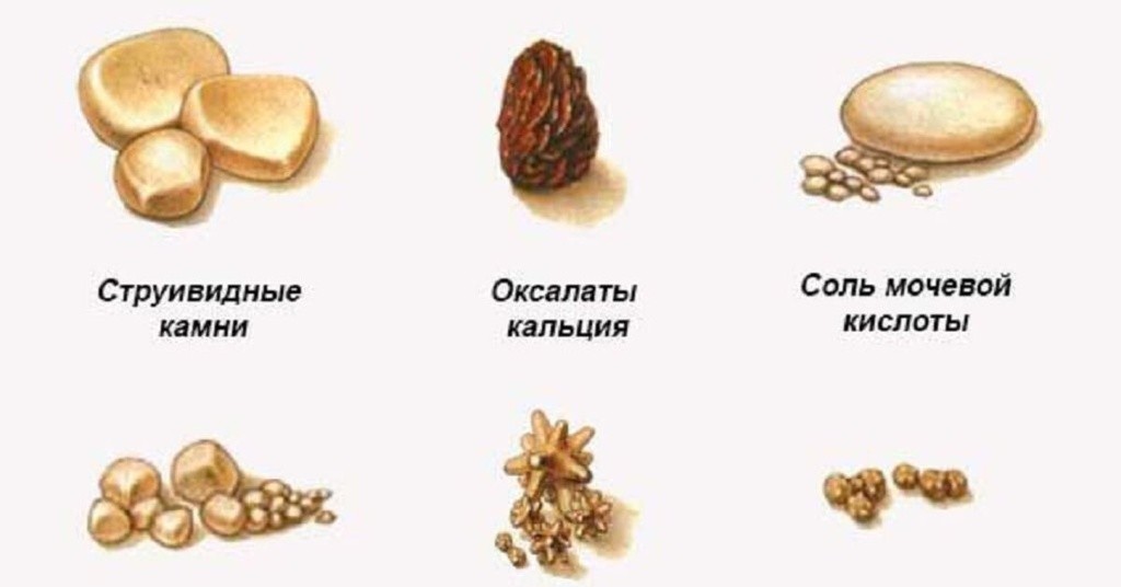 Какими бывают камни в почках
