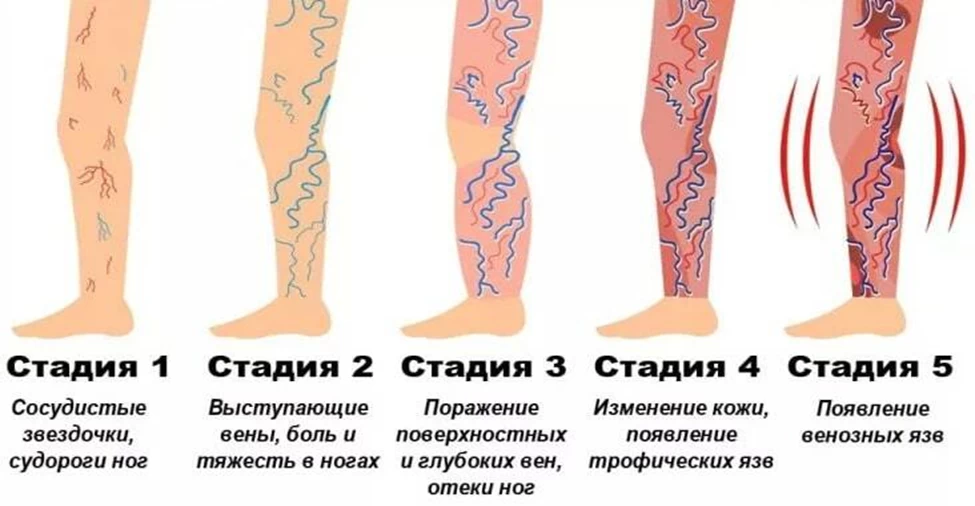 Варикоз вен ног, лечение и профилактика