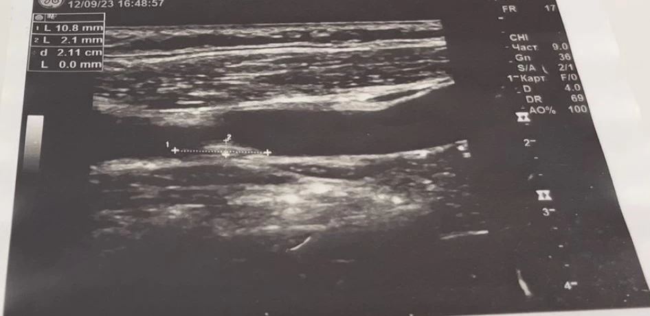 ПОТЕНЦИАЛЬНЫЕ РИСКИ И ОСЛОЖНЕНИЯ ПОВЕРХНОСТНОГО И ГЛУБОКОГО ВАРИКОЗА.jpg ПОТЕНЦИАЛЬНЫЕ РИСКИ И ОСЛОЖНЕНИЯ ПОВЕРХНОСТНОГО И ГЛУБОКОГО ВАРИКОЗА.jpg